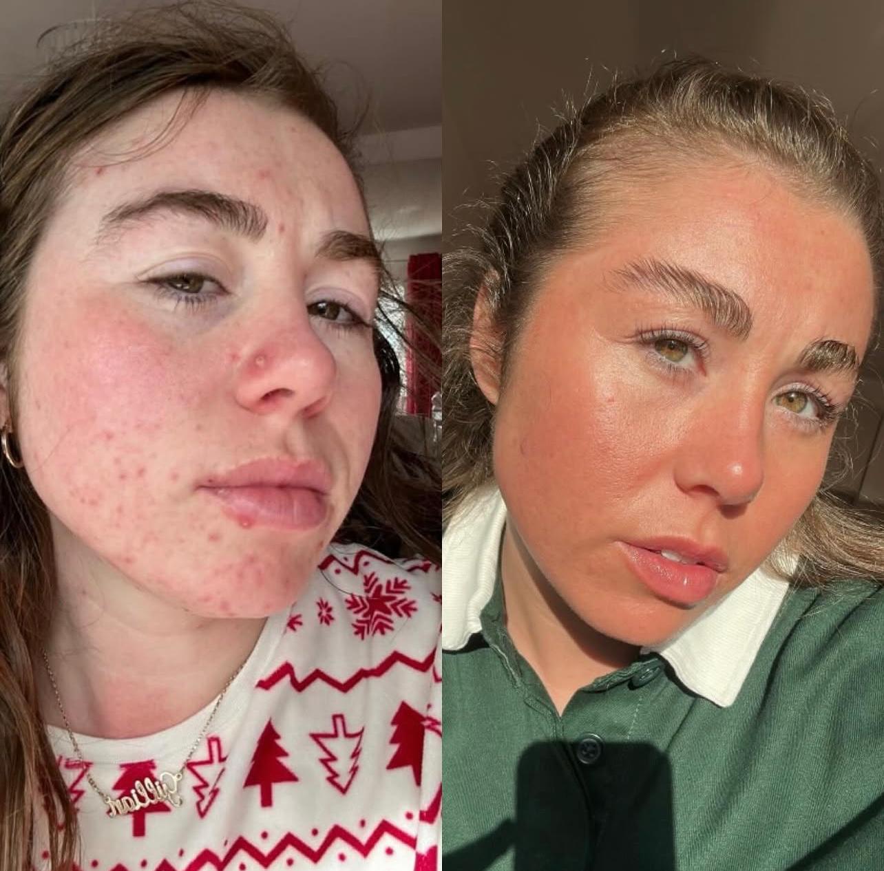 Client skin transformation, before and after care at The Skin Space